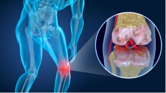 Osteoporosis